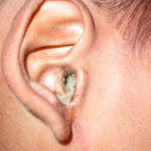 Tinnitus
